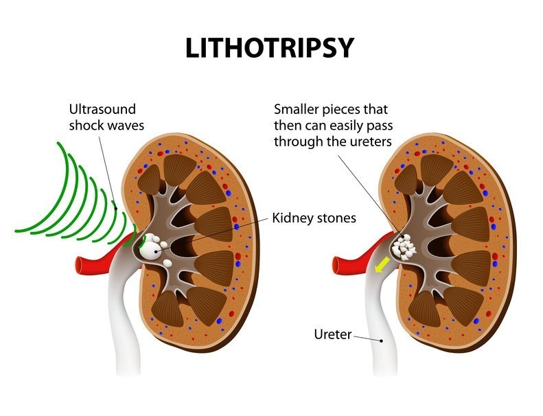 lithotripsy