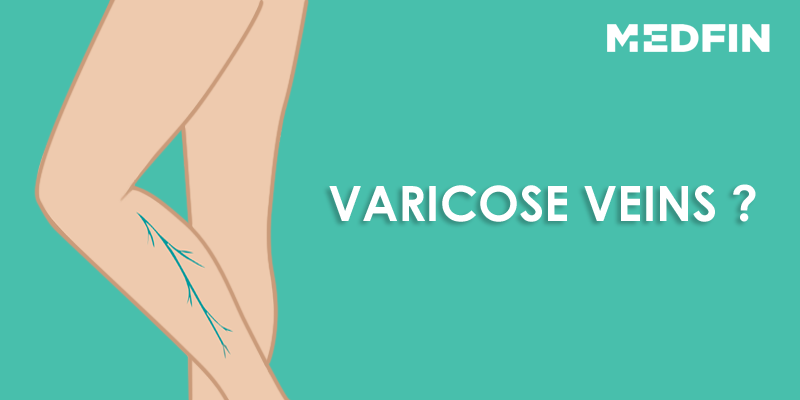 What_is_varicose_veins?