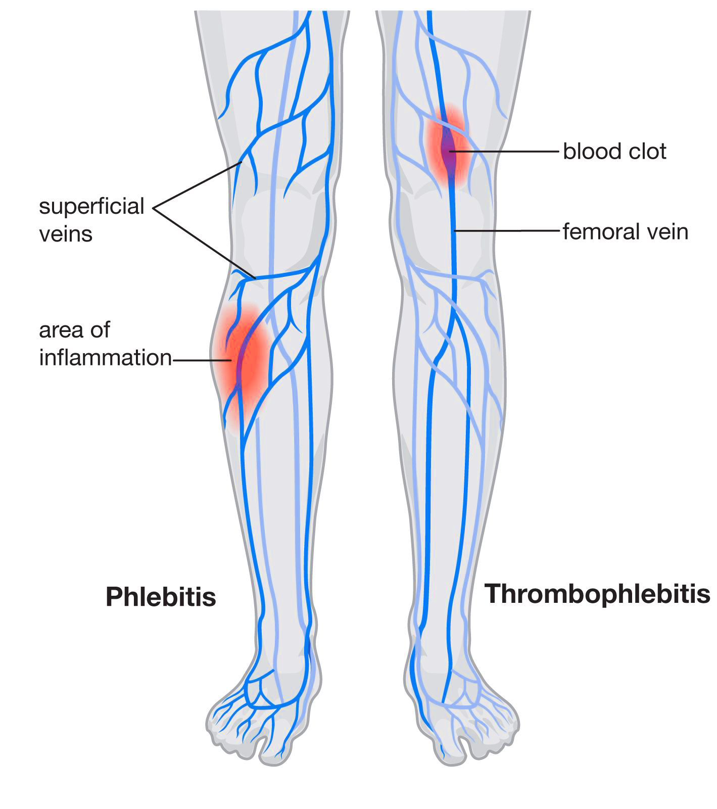 Superficial thrombophlebitis can pose grave health risks