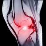 acl-surgery-debnking-myths
