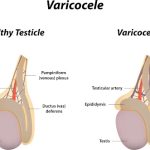 inverse-varicose-veins-in-scrotum