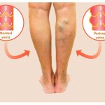 treating-and-preventing-varicose-veins