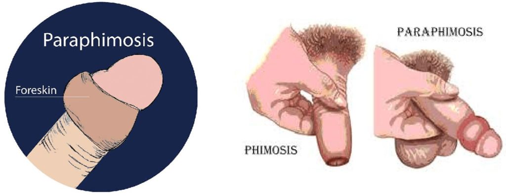 Phimosis and ischaemia of the glans penis, both clinical signs of