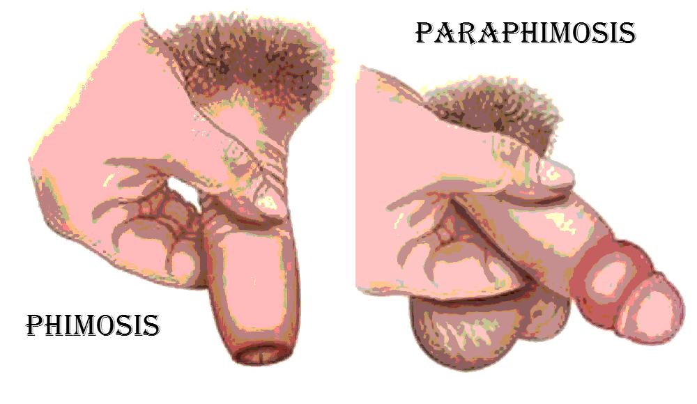Phimosis and Paraphimosis in Children: What Parents Need to Know